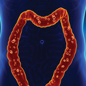 Colon Cancer: Why Screening is Important